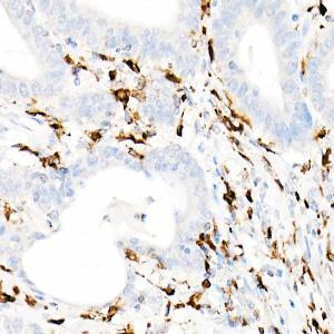 Immunohistochemistry analysis of paraffin-embedded human colon carcinoma tissue using Anti-CD74 Antibody [ARC1452] (A307423) at a dilution of 1:100 (40X lens). Perform high pressure antigen retrieval with 10 mM Tris/EDTA buffer pH 9.0 before commencing with IHC staining protocol