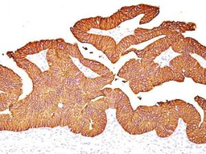 Immunohistochemical analysis of formalin-fixed, paraffin-embedded human colon carcinoma using Anti-EpCAM Antibody [EGP40/837]