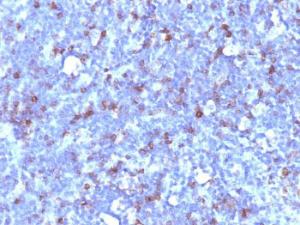 Immunohistochemical analysis of formalin-fixed, paraffin-embedded human lymphoma using Anti-CD43 Antibody [SPN/1094]