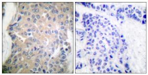 Immunohistochemical analysis of paraffin-embedded human breast carcinoma tissue using Anti-CPI17 alpha Antibody. The right hand panel represents a negative control, where the antibody was pre-incubated with the immunising peptide