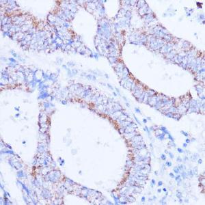 Immunohistochemistry analysis of paraffin-embedded human colon carcinoma tissue using Anti-SIRT3 Antibody (A308368) at a dilution of 1:100 (40x lens) Perform microwave antigen retrieval with 10 mM PBS buffer pH 72 before commencing with IHC staining protocol