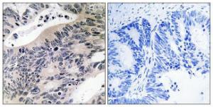 Immunohistochemical analysis of paraffin-embedded human colon carcinoma tissue using Anti-ACSS1 Antibody. The right hand panel represents a negative control, where the antibody was pre-incubated with the immunising peptide.