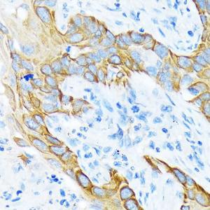 Immunohistochemistry analysis of paraffin-embedded human lung squamous carcinoma tissue using Anti-Cytokeratin 4 Antibody [ARC1804] (A307427) at a dilution of 1:100 (40x lens). Perform microwave antigen retrieval with 10 mM Tris/EDTA buffer pH 9.0 before commencing with IHC staining protocol.