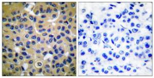 Immunohistochemical analysis of paraffin-embedded human breast carcinoma tissue using Anti-Collagen II Antibody The right hand panel represents a negative control, where the antibody was pre-incubated with the immunising peptide