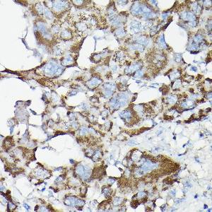 Immunohistochemistry analysis of paraffin-embedded human liver cancer using Anti-NF-kB p65 Antibody (A80443) at a dilution of 1:200 (40X lens). Perform high pressure antigen retrieval with 10 mM citrate buffer pH 6.0 before commencing with IHC staining protocol