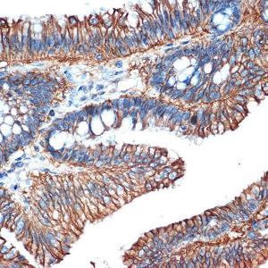 Immunohistochemistry analysis of paraffin-embedded human colon carcinoma tissue using Anti-LI Cadherin Antibody [ARC1989] (A307438) at a dilution of 1:100 (40X lens). Perform microwave antigen retrieval with 10 mM Tris/EDTA buffer pH 9.0 before commencing with IHC staining protocol