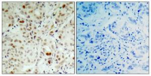 Immunohistochemical analysis of paraffin-embedded human breast carcinoma using Anti-Retinoblastoma (phospho Ser807) Antibody. The right hand panel represents a negative control, where the antibody was pre-incubated with the immunising peptide.