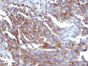 Immunohistochemical analysis of formalin-fixed, paraffin-embedded human breast using Anti-CD44 Antibody [HCAM/6459R]