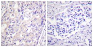 Immunohistochemical analysis of paraffin-embedded human breast carcinoma using Anti-p90 RSK (phospho Thr359+Ser363) Antibody. The right hand panel represents a negative control, where the antibody was pre-incubated with the immunising peptide.