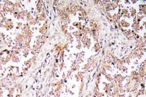 Immunohistochemical analysis of paraffin-embedded human lung carcinoma tissue using Anti-UCP2 Antibody