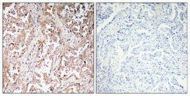 Immunohistochemical analysis of paraffin-embedded human lung cancer using Anti-UCP2 Antibody 1:100 (4 °C overnight). The right hand panel represents a negative control, where the Antibody was pre-incubated with the immunising peptide