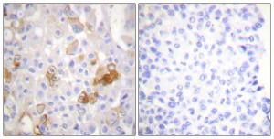 Immunohistochemical analysis of paraffin-embedded human breast carcinoma using Anti-Integrin beta1 (phospho Thr788) Antibody. The right hand panel represents a negative control, where the Antibody was pre-incubated with the immunising peptide