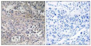 Immunohistochemical analysis of paraffin-embedded human breast carcinoma tissue using Anti-TUFM Antibody. The right hand panel represents a negative control, where the antibody was pre-incubated with the immunising peptide