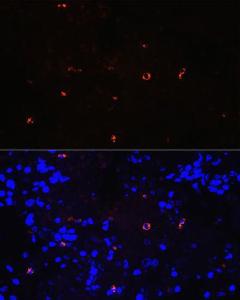 Immunofluorescence analysis of human lung cancer using Anti-Lysozyme Antibody [ARC0276] (A307449) at a dilution of 1:100 (40X lens). DAPI was used to stain the cell nuclei (blue)