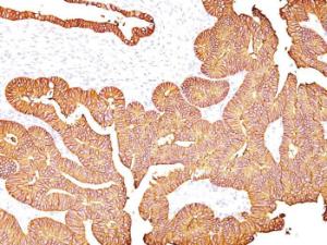 Immunohistochemical analysis of formalin-fixed, paraffin-embedded human colon carcinoma using Anti-EpCAM Antibody [323/A3]