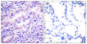 Immunohistochemical analysis of paraffin-embedded human lung carcinoma using Anti-PP2A-alpha (phospho Tyr307) Antibody. The right hand panel represents a negative control, where the antibody was pre-incubated with the immunising peptide