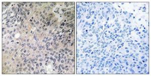 Immunohistochemical analysis of paraffin-embedded human lung carcinoma tissue using Anti-SHC3 Antibody. The right hand panel represents a negative control, where the antibody was pre-incubated with the immunising peptide