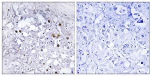 Immunohistochemical analysis of paraffin-embedded human liver carcinoma using Anti-HNF4 alpha (phospho Ser313) Antibody. The right hand panel represents a negative control, where the antibody was pre-incubated with the immunising peptide