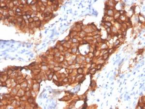 Immunohistochemical analysis of formalin-fixed, paraffin-embedded human breast carcinoma using Anti-HER2 Antibody [ERBB2/4439]