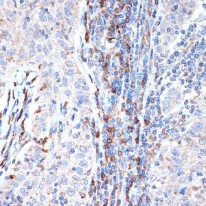 Immunohistochemistry analysis of paraffin-embedded human esophageal cancer using Anti-Dcp1a Antibody [ARC1421] (A10006) at a dilution of 1:100 (40X lens). Perform microwave antigen retrieval with 10 mM Tris/EDTA buffer pH 9.0 before commencing with IHC staining protocol