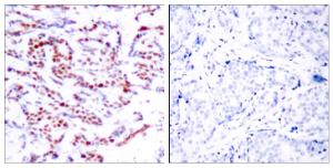 Immunohistochemical analysis of paraffin-embedded human breast carcinoma using Anti-ATF2 (phospho Ser112 or 94) Antibody. The right hand panel represents a negative control, where the antibody was pre-incubated with the immunising peptide