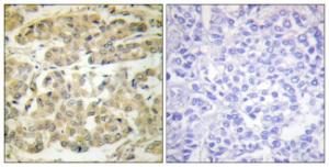 Immunohistochemical analysis of paraffin-embedded human breast carcinoma using Anti-14-3-3 zeta (phospho Ser58) Antibody. The right hand panel represents a negative control, where the antibody was pre-incubated with the immunising peptide.