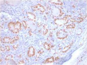 Immunohistochemical analysis of formalin-fixed, paraffin-embedded human lung adenocarcinoma using Anti-TTF1 Antibody [rNX2.1/690]