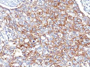 Immunohistochemical analysis of formalin-fixed, paraffin-embedded human breast carcinoma using Anti-EpCAM Antibody [EGP40/826]