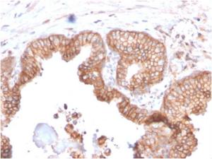 Immunohistochemical analysis of formalin-fixed, paraffin-embedded human prostate carcinoma using Anti-CD47 Antibody [CD47/2937]