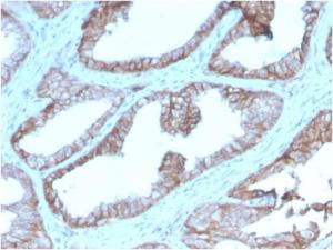 Immunohistochemical analysis of formalin-fixed, paraffin-embedded human prostate carcinoma using Anti-CD47 Antibody [CD47/2937]