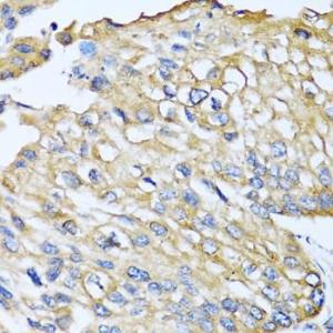 Immunohistochemistry analysis of paraffin-embedded human prostate cancer using Anti-MCP2 Antibody (A10037) at a dilution of 1:100 (40x lens). Perform microwave antigen retrieval with 10 mM PBS buffer pH 7.2 before commencing with IHC staining protocol