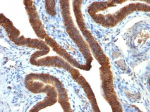 Immunohistochemical analysis of formalin-fixed, paraffin-embedded human ovarian carcinoma using Anti-EpCAM Antibody [EGP40/837]