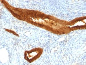 Immunohistochemical analysis of formalin-fixed, paraffin-embedded human endometrial cancer using Anti-EpCAM Antibody [EGP40/837]