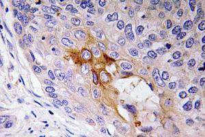 Immunohistochemical analysis of paraffin-embedded human lung carcinoma tissue using Anti-NF-L Antibody