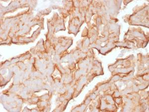 Immunohistochemical analysis of formalin-fixed, paraffin-embedded human ovarian carcinoma using Anti-MUC16 Antibody [OCA125/1900]