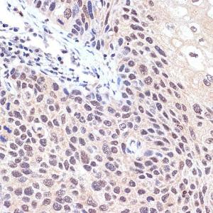 Immunohistochemistry analysis of paraffin-embedded human esophageal cancer using Anti-TNPO3 Antibody [ARC2310] (A308395) at a dilution of 1:100 (40x lens)