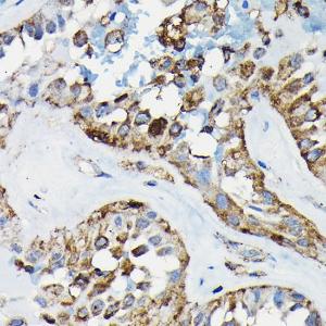 Immunohistochemistry analysis of paraffin-embedded human thyroid cancer using Anti-PRC1 Antibody (A10047) at a dilution of 1:100 (40X lens). Perform high pressure antigen retrieval with 10 mM citrate buffer pH 6.0 before commencing with IHC staining protocol