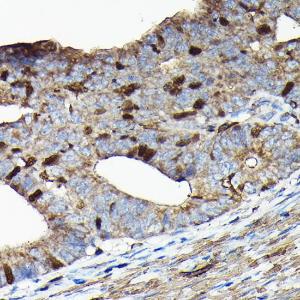 Immunohistochemistry analysis of paraffin-embedded human colon carcinoma tissue using Anti-PRC1 Antibody (A10047) at a dilution of 1:100 (40X lens). Perform high pressure antigen retrieval with 10 mM citrate buffer pH 6.0 before commencing with IHC staining protocol