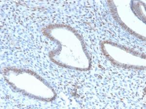 Immunohistochemical analysis of formalin-fixed, paraffin-embedded human endometrial carcinoma using Anti-TLE1 Antibody [TLE1/2946R]