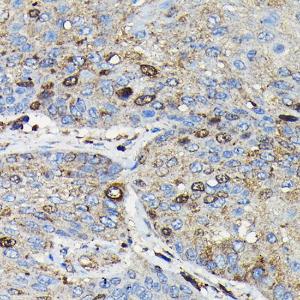 Immunohistochemistry analysis of paraffin-embedded human esophageal cancer using Anti-PRC1 Antibody (A10047) at a dilution of 1:100 (40X lens). Perform high pressure antigen retrieval with 10 mM citrate buffer pH 6.0 before commencing with IHC staining protocol