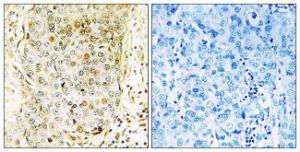 Immunohistochemical analysis of paraffin-embedded human breast carcinoma tissue using Anti-mlK3 Antibody. The right hand panel represents a negative control, where the antibody was pre-incubated with the immunising peptide