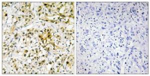 Immunohistochemical analysis of paraffin-embedded human liver carcinoma tissue using Anti-LEG4 Antibody. The right hand panel represents a negative control, where the antibody was pre-incubated with the immunising peptide.