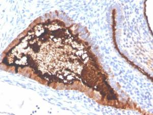 Immunohistochemical analysis of formalin-fixed, paraffin-embedded human ovarian carcinoma using Anti-MUC16 Antibody [OCA125/4505R]