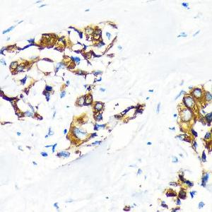 Immunohistochemistry analysis of paraffin-embedded human lung cancer using Anti-AGR2 Antibody (A10053) at a dilution of 1:100 (40X lens). Perform microwave antigen retrieval with 10 mM PBS buffer pH 7.2 before commencing with IHC staining protocol