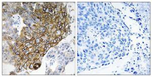 Immunohistochemical analysis of paraffin-embedded human lung carcinoma tissue using Anti-GJA3 Antibody. The right hand panel represents a negative control, where the antibody was pre-incubated with the immunising peptide.