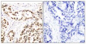 Immunohistochemical analysis of paraffin-embedded human breast carcinoma tissue using Anti-Elk1 Antibody. The right hand panel represents a negative control, where the Antibody was pre-incubated with the immunising peptide