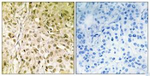 Immunohistochemical analysis of paraffin-embedded human breast carcinoma using Anti-DNA Polymerase thet Antibody. The right hand panel represents a negative control, where the antibody was pre-incubated with the immunising peptide