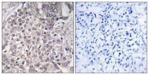 Immunohistochemical analysis of paraffin-embedded human liver carcinoma using Anti-Cytochrome P450 4F2 Antibody The right hand panel represents a negative control, where the antibody was pre-incubated with the immunising peptide