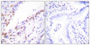 Immunohistochemical analysis of paraffin-embedded human lung carcinoma tissue using Anti-Ki67 Antibody. The right hand panel represents a negative control, where the antibody was pre-incubated with the immunising peptide.