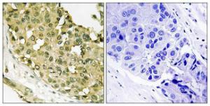 Immunohistochemical analysis of paraffin-embedded human breast carcinoma using Anti-STMN1 (phospho Ser62) Antibody. The right hand panel represents a negative control, where the antibody was pre-incubated with the immunising peptide.